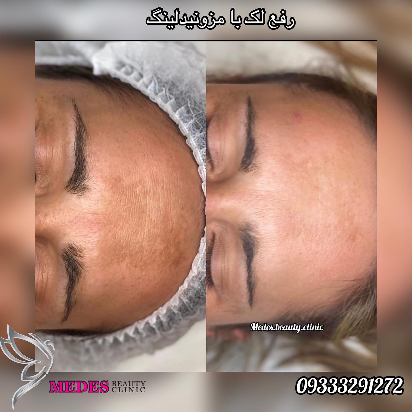 گالری مزونیدلینگ